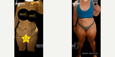 35-44 year old woman treated with Tummy Tuck, Body Lift, Back Lift - 35-44-year-old woman treated with Mommy Makeover, Breast Augmentation, Tummy Tuck, Breast Lift