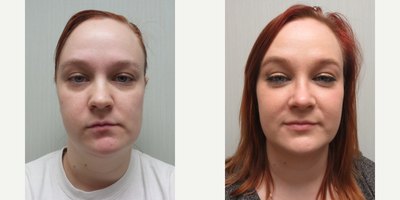 25-34 year old woman treated with Rhinoplasty - This patient underwent a Rhinoplasty