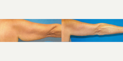 Woman treated with Arm Lift - Woman treated with Arm Lift