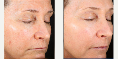 55-64 year old woman treated with Renuvion, Renuvion for Facial Resurfacing - 55-64 year old woman treated with Renuvion, Renuvion for Facial Resurfacing