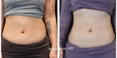 Woman treated with Emsculpt - EMSCULPT Neo is the first and only non-invasive body shaping procedure that provides simultaneous fat elimination and muscle building in a combined 30-minutes session.These after pictures are only after two sessions!