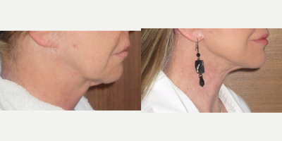 63 year old woman treated with Neck Lift - 63 year old female undergoing necklift under sedation