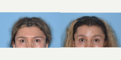 Woman treated with Brow Lift - Woman treated with endoscopic Brow Lift