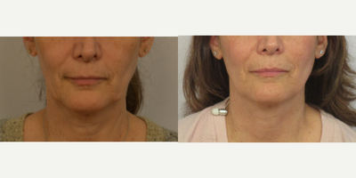 55-64 year old woman treated with Profound RF - 57 years old female wanting to improve jawline and overall firmness of skin, patient was treated with Profound RF and PRP