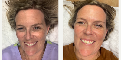45-54 year old woman treated with Skin Lightening - Before and after of one Perfect Derma chemical peel. Peel is medium depth and removes about 2-3 layers of dead skin cells.