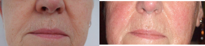 TriPollar - 
	Facial skin tightening after 2 treatments. Photos supplied by manufacturer, Pollogen Ltd, All Rights Reserved.
