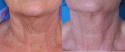 TriPollar - 
	Neck skin tightening after 6 treatments. Photos supplied by manufacturer, Pollogen Ltd, All Rights Reserved.
