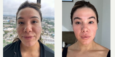 25-34 year old woman treated with Bellafill, Microneedling RF, Halo Laser, CO2 Laser - Our patient is here for her second treatment with us to see further improvement with her acne scars. She has some deeper scars on her cheeks, called 'ice pick' scars. To visibly reduce the irregular texture on her cheeks we did an action packed combo treatment consisting of TCA cross, Bellafill, Pixel8-RF, Halo, and CO2 laser. We didn't stop there though- after care is a crucial part of the healing process so we made sure to set her up for success. We applied the Emer Skin Hyla-B and Hydration mask immediately after treatment to keep her skin calm, moisturized, and hydrated. On top of that, we used Anteage exsomes mixed with PRP to decrease redness and set her on the right path for her healing process. You thought we were finished there? Not quite. We then gave her the newest facial on the block: Glacial. We love combining this with any laser treatment plus the Emer Skin Hydration Mask, because it reduces skin inflammation and swelling, as well as calms and soothes her skin. She is very happy with her results and is loving the significant improvement she has seen after only two treatments with us!