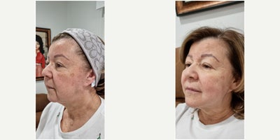 65-74 year old man treated with Thread Lift - Thread lift