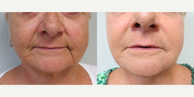 55-64 year old woman treated with Juvederm - This patient softened her Peri-Oral area with Juvederm