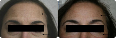Pixel Laser - Use od Pixel Laser for Skin Resurfacing.