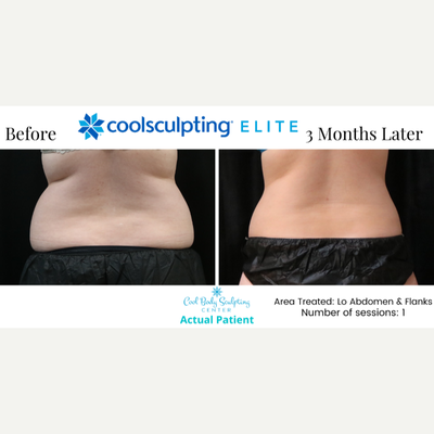 35-44 year old woman treated with CoolSculpting Elite - CoolSculpting results at Cool Body Sculpting Center