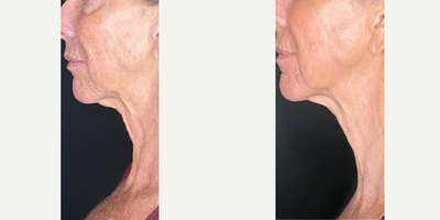 55-64 year old woman treated with Opus Plasma, IPL, Fractional Laser - This client wanted to address her skin laxity and hyper-pigmentation. We chose to do a series of combination treatments. This is 4 weeks after her 3rd treatment!
