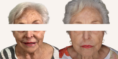 55-64 year old woman treated with SkinPen, HydraFacial - The SkinPen microneedling device causes controlled micro-injuries that stimulate the body's natural wound healing process. The micro-injuries trigger the release of cytokines and growth factors that lead to remodeling of collagen and elastin. SkinPen is FDA approved.The Signature HydraFacial is a 30-minute procedure that deeply cleanses, extracts, and hydrates the skin through our super serums filled with antioxidants, peptides, and hyaluronic acids. The Signature HydraFacial is great for all skin types to cleanse, exfoliate and hydrate.Regular HydraFacial and SkinPen treatments can lead to great results.