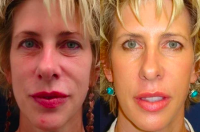 Active/Deep FX Laser - 	Uses the Active/Deep FX laser to improve the patient's skin texture and reduce wrinkles on her face.