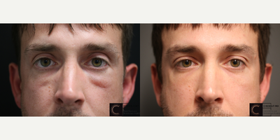 Misplaced lower eyelid filler corrected - Misplaced lower eyelid filler corrected