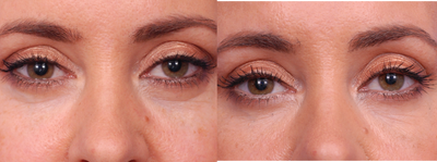 Belotero lower eyelid - Belotero Balance to lower eyelids and tear trough.