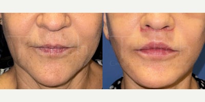 55-64 year old woman treated with Lip Lift, Lip Surgery - 60 year old woman who underwent lip lift at the time of complete facial rejuvenation.