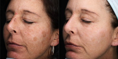 45-54 year old woman treated with Pico Genesis - Patient wanted sun spots to dissipate and to refreshen the skin.