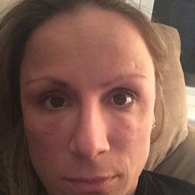 How much swelling is normal after Restylane injections ...