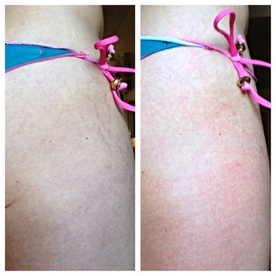 Stretch at Cellulite Rolling Marks, Home for Derma