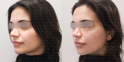 35-44 year old woman treated with Potenza, Thermage FLX, Skin Tightening, Pico Genesis, PicoSure, Collagen Injection - This patient came in with concerns including undereye hollowness, pigmentation, brown spots, enlarged pores, and acne scars. Her Mark-Vu skin analysis showed signs of sun damage, uneven tone, and early skin laxity.We addressed these concerns with a personalized, combination treatment plan:Collagen Injection (Under Eyes, Nasolabial Folds): To improve volume loss and dark hollowing.PicoSure + Genesis Laser: Targeted pigmentation, brown spots, and acne scarring.Thermage FLX (Eye Area): Focused tightening and collagen stimulation around the delicate periorbital region.ONDA Lifting (Cheeks): For skin tightening and facial contour improvement in the mid-face.Potenza RF Microneedling + Exosomes: To refine skin texture, reduce pore size, and further treat acne scars and dullness.This multi-modal approach significantly improved her skin tone, texture, and firmness, restoring a more refreshed and youthful look.
