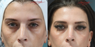 35-44 Years Old Woman Treated with Mole Removal - Final version of our female patient; whose recruitment process was completed successfully; after mole removal technique.