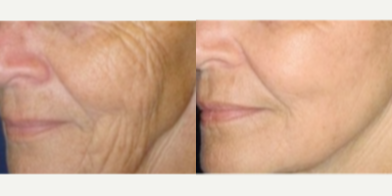 65-74 year old woman treated with Fractionated CO2 Laser Skin Resurfacing - This patient came in to find out what could be done to recapture a more youthful appearance. After taking time to understand her goals and the components of her aging pattern, I created a treatment plan that included fractionated CO2 laser skin resurfacing (she also had a facelift and necklift). Her postop pictures are 3 months after her treatment.