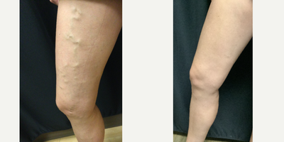 Sclerotherapy and RFA - Pre vs Post treatment of sclerotherapy & vein ablation