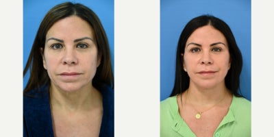 45-54 year old woman treated with Mini Facelift, Neck Lift, TCA Peel - 54 year old woman 3 months after neck lift with mini facelift performed by Dr Sam Gershenbaum. She also had some fat transfer to the face as well as a TCA peel to the lower eyelids. Her scars are imperceptible. She loves the many compliments she has received after her procedure. She is thrilled with her results.