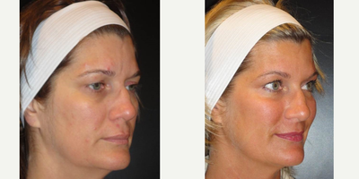 35-44 year old woman treated with Voluma - Voluma treatment done to lift cheeks, soften tear troughs (under eye shadows), and soften nasolabial creases, and Botox to frown lines, crow's feet, and brow lift.
