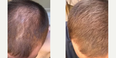 Man treated with Mesotherapy - Man treated with Mesotherapy