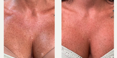 45-54 year old woman treated with Skin Tightening, Sculptra, Opus Plasma - Chest lines? Texture concerns? This client had a combination of Sculptra and an Opus Plasma to help with her concerns.