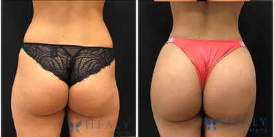 Woman treated with Butt Augmentation - This patient got a butt augmentation with fat transfer to lateral hips.