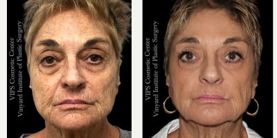 65-74 year old woman treated with Skin Rejuvenation, CO2 Laser - This 65-74 year old patient wanted to refresh her skin and reduce signs of aging without undergoing surgery. After a Deep CO2 Laser Skin Resurfacing treatment, she experienced a dramatic improvement in skin texture, tone, and overall radiance. Fine lines, deep wrinkles, and laxity were noticeably reduced as this advanced laser technology stimulated collagen production for firmer, more youthful-looking skin. While Deep CO2 Laser Resurfacing requires approximately two weeks of downtime, patients choose it for its intense, transformative results that significantly rejuvenate the skin.