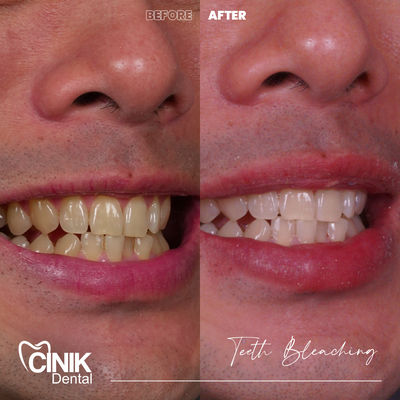 25-34 year old man treated with Teeth Whitening - Teeth Whitening