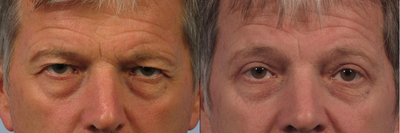 Male upper eyelid lift -
Removal of heavy upper eyelid skin