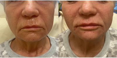67 year-old treated with filler to the lips , cheeks, and chin - Woman treated with filler to the Lips, Cheeks, Nasolabial Fold, Chin, Marionette Lines with Radiesse and Ravenesse Versa.