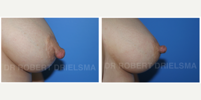 35-44 year old woman treated with Nipple Surgery - 43 yo woman with enlarged cracking nipples corrected with nipples reduction surgery