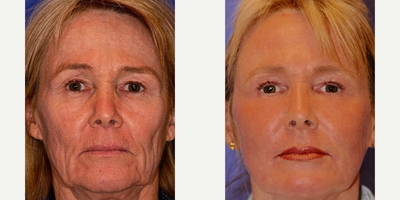 65-74 year old woman treated with Active FX - 1 Active Fx and 1 Max FX done 1 year apart. Patient wanted to try a light laser treatment but decided to get the max co2 laser after trying the lighter procedure.