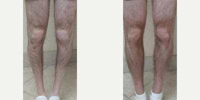 35-44 year old man treated with Body Jet - 38 year old male with extremely skinny lower legs and lack of calf muscle asking for liposuction of the flanks and stem and fat cell transfer for creation of stronger and larger calf muscles. The patient is seen before and one year after the initial stage of calf muscle construction. No compression garments used, results are permanent with greater muscle bulk and much greater strength.