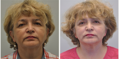 65-74 year old woman treated with Facelift - 68 year old female 2 years following a facelift with a neck lift, facial fat grafting and upper eyelid lift (Blepharoplasty).