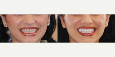 Woman treated with Full Mouth Reconstruction, Dental Crown, Porcelain Veneers - This patients teeth had become ground down due to clenching and grinding. She was also unhappy with the color. Using 20 Infinity Veneers and crowns, Dr. Maddahi was able to give her a much more youthful smile that better fit the shape of her face.