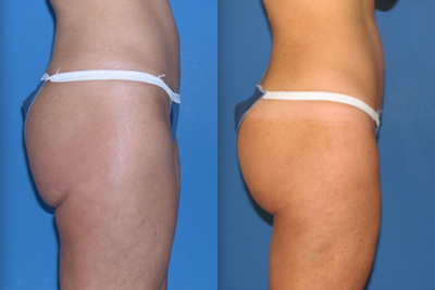 Butt Lift - 37 yo female who underwent a Del Mar butt tuck