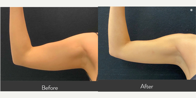 35-44 year old woman treated with CoolSculpting Elite - Our 38 yr old female patient had 1 CoolSculpting Elite session to her upper arms. She is shown before and only 6 weeks after treatment.
