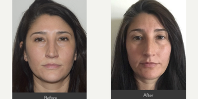 35-44 year old woman treated with AccuTite - Our 41 yr. old patient had Accutite to the lower eyelids. She is shown before and 9 months after treatment. Results are often noticeable after 6 weeks, but continue to improve over time.