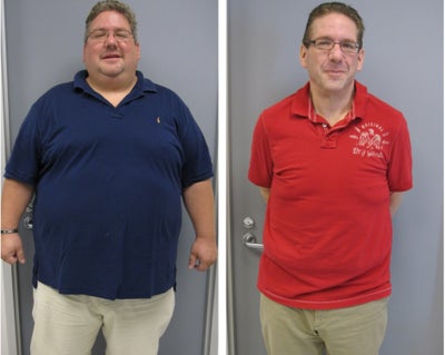 Before & After - 
	24 months post-op
