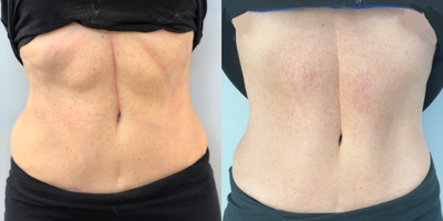 45-54 year old woman treated with Morpheus8 - Patient is 8 months post one Morpheus body treatment