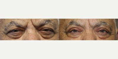 65-74 year old man treated with Ptosis Repair - Ptosis Repair