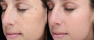 25-34 year old woman treated with BroadBand Light (BBL) - BroadBand Light (BBL) 2 weeks after one treatment